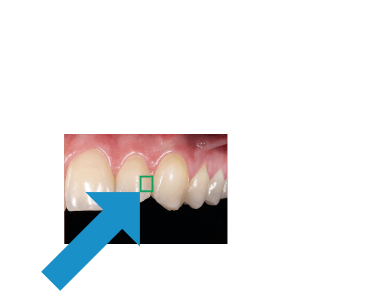 dental-camera-dentaleyepad-animation-compare-camera-screen-tooth
