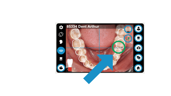 dental-camera-dentaleyepad-animation-compare-dentaleyepad-screen-lower-jaw