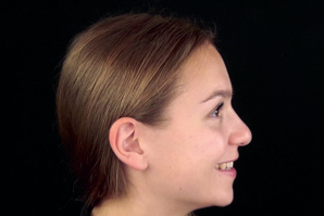 dentaleyepad Beispielfoto Profil von rechts lächelnd