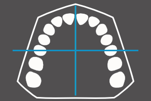 dentaleyepad overlay Modell Oberkiefer