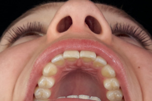 dentaleyepad beispielfoto Oberkiefer aus 90 grad