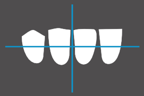 dentaleyepad overlay Unterkiefer schräg links