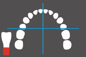 dentaleyepad overlay okklusal Oberkiefer gespiegelt